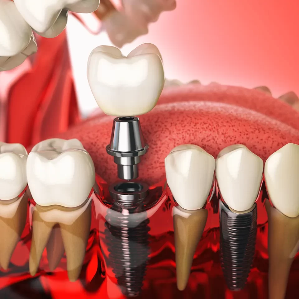 Dental Bridges Dental Bridges