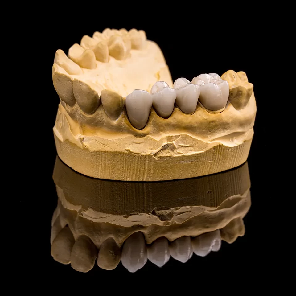 Dental Crowns Dental Crowns