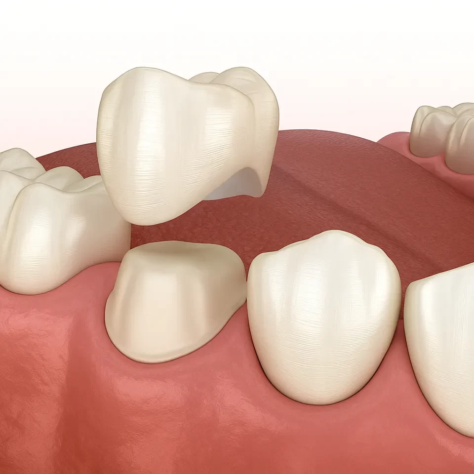Dental Crowns Dental Crowns