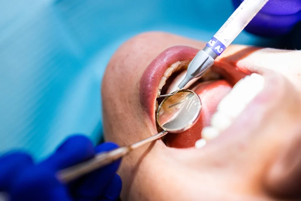 Exploring the Best Alternatives to Dental Fillings for Your Oral Health