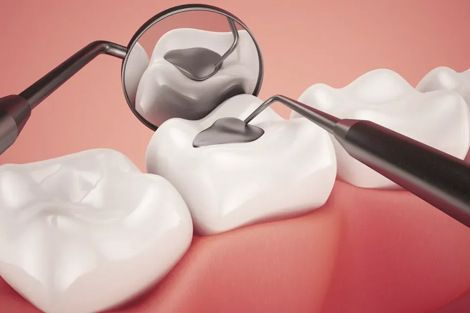 Dental Fillings-02