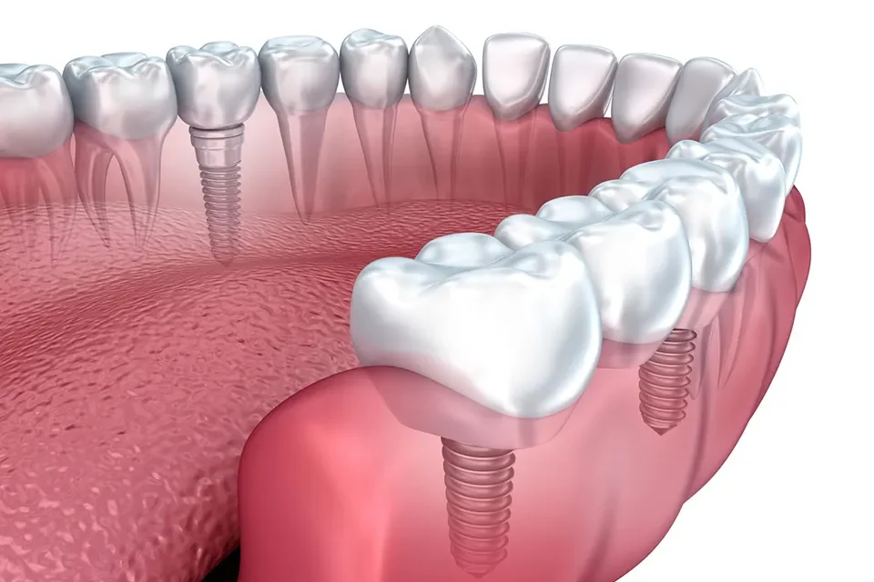 Dental Implants-01