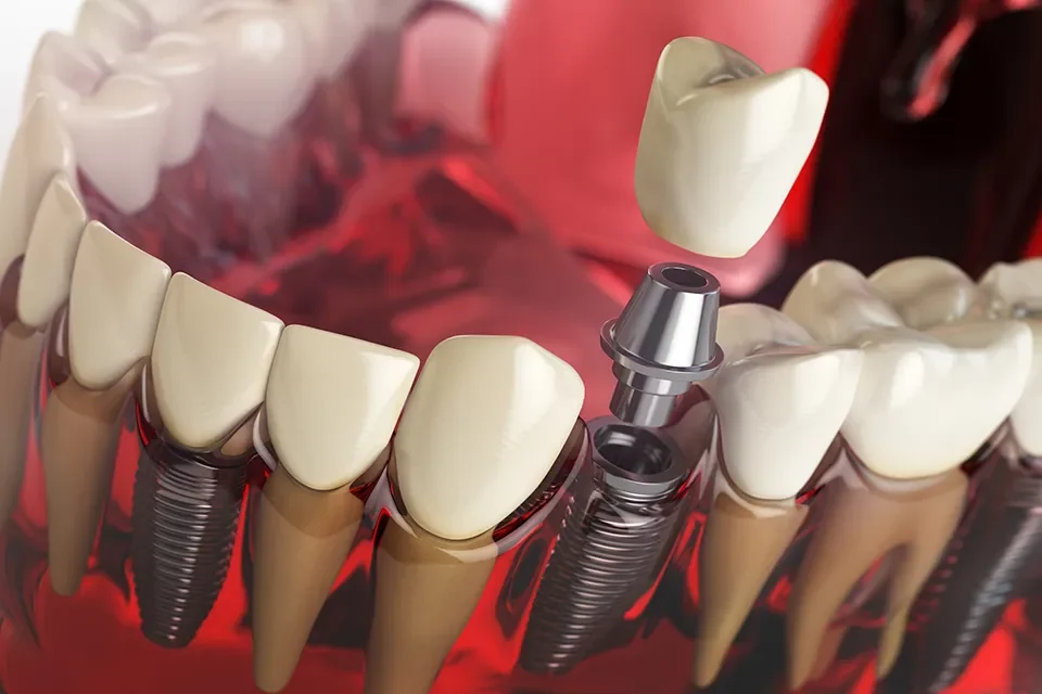 Dental Implants-04