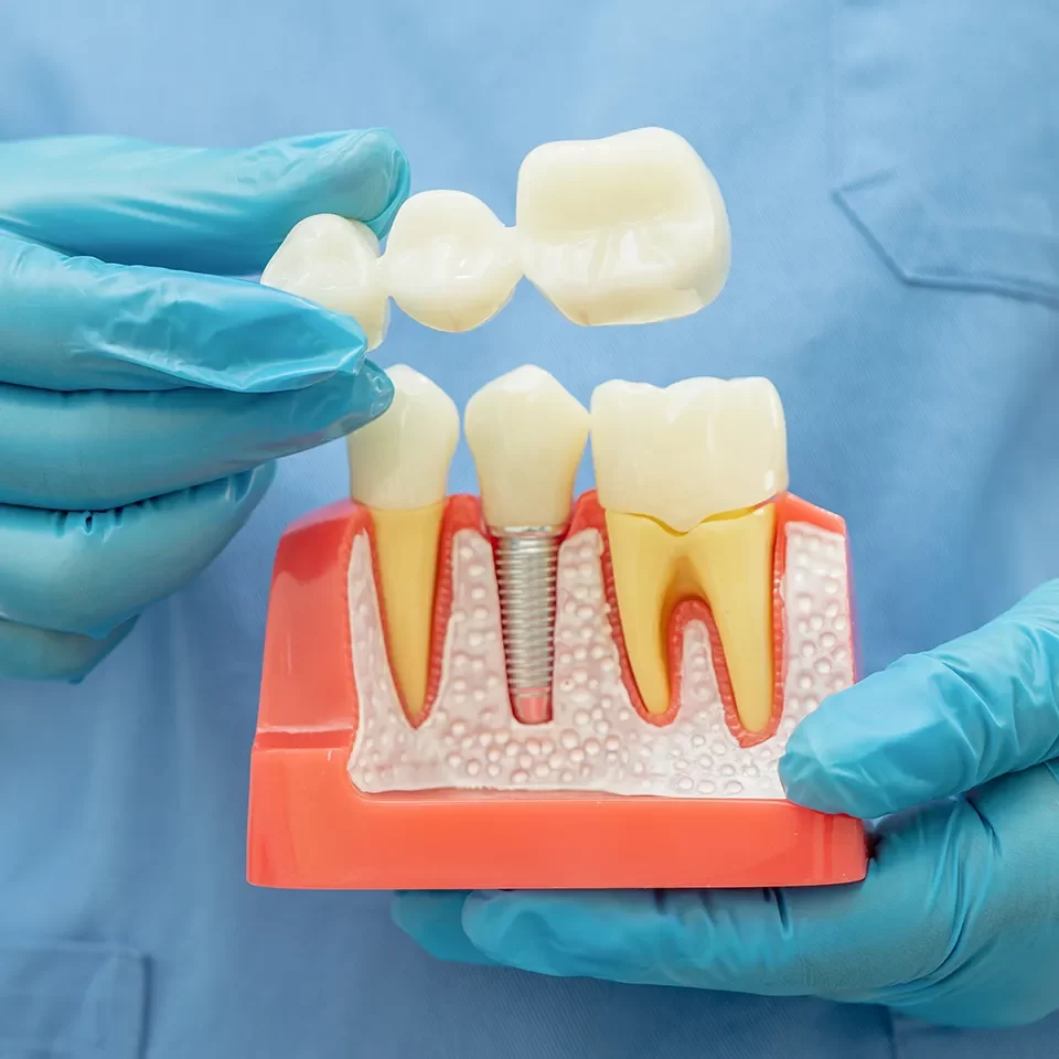 Dental Implants Dental Implants