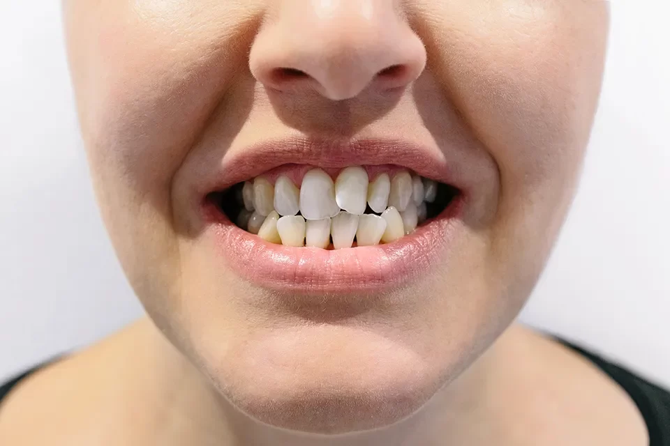 Crooked Teeth.