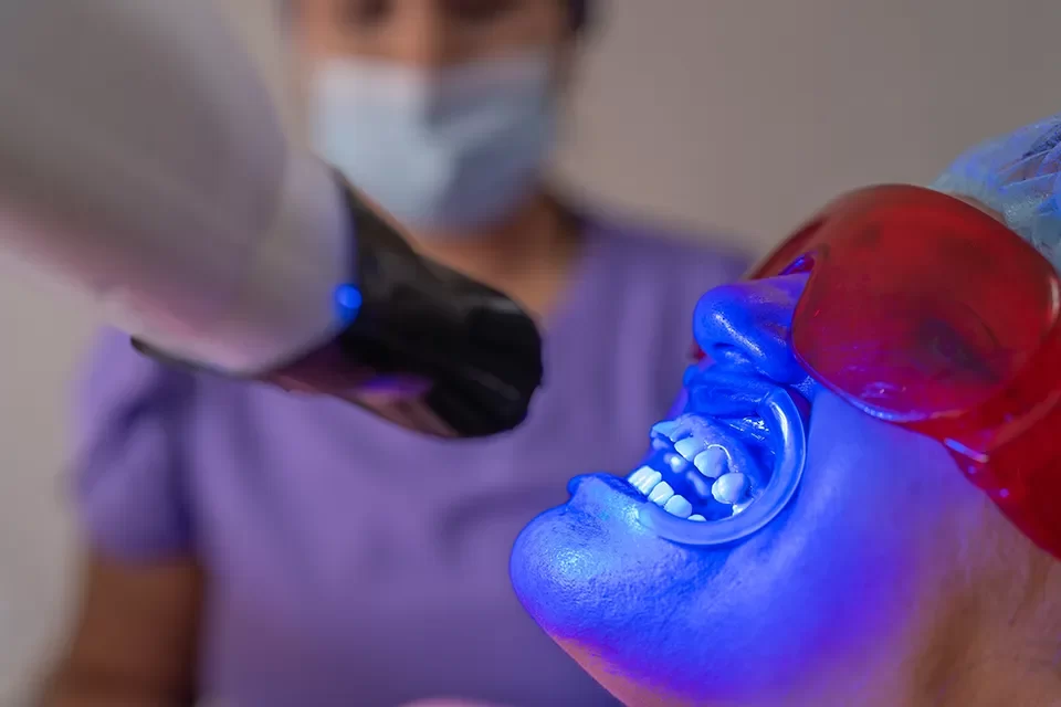 Dental Veneers vs. Teeth Whitening: The Procedure