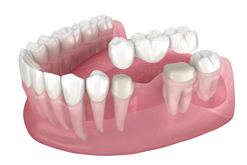 Denture Treatment-04