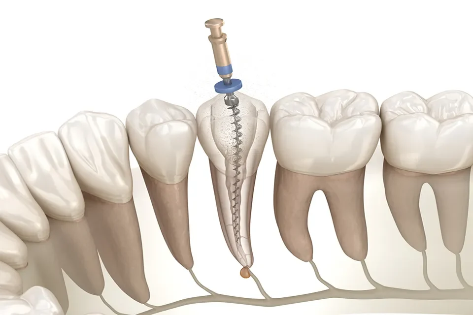 Endodontics-03