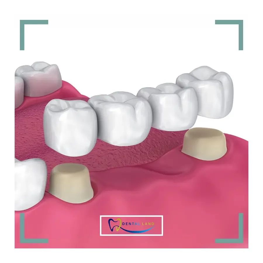 A Fixed Partial Denture as a permanent solution for missing teeth, enhancing oral functionality and aesthetics