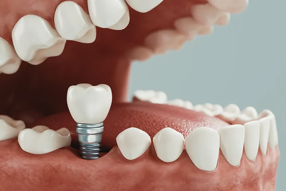 Gentle Root Canal Treatment in Toronto