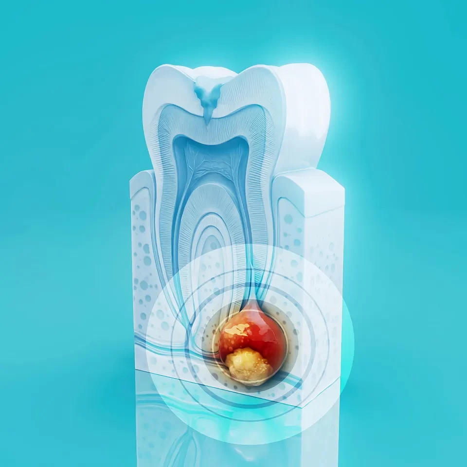 Gentle Root Canal Treatment in Toronto