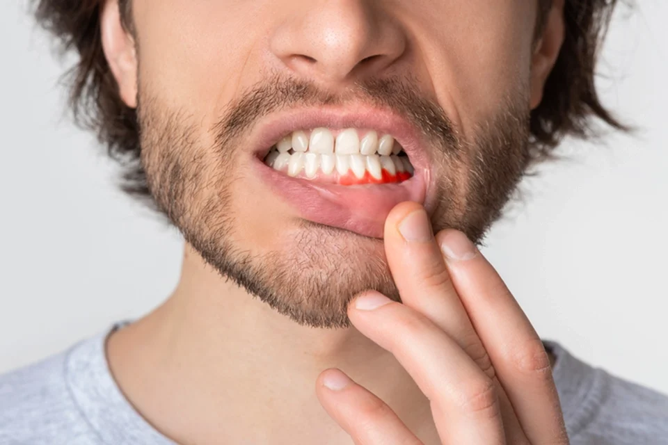 Key Strategies for Preventing Gum Infections