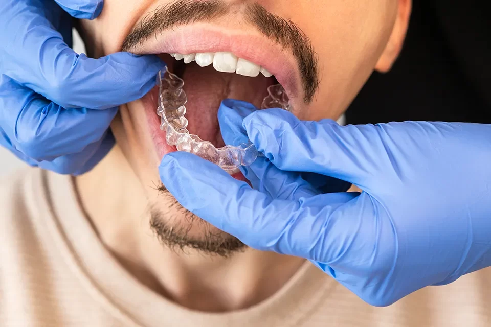 Invisalign Factors Influencing Invisalign Cost Toronto