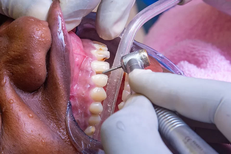 Steps to Keeping Gums Healthy