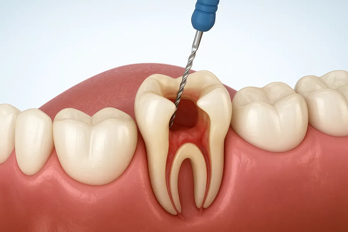 Root Canal Therapy Root Canal Therapy