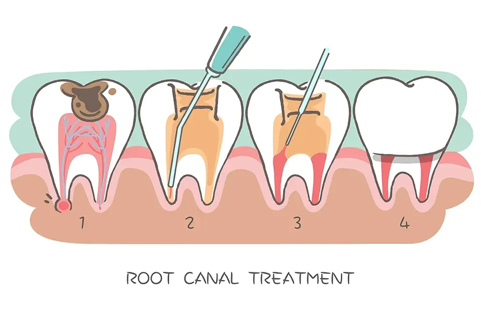 Root Canal Therapy-03