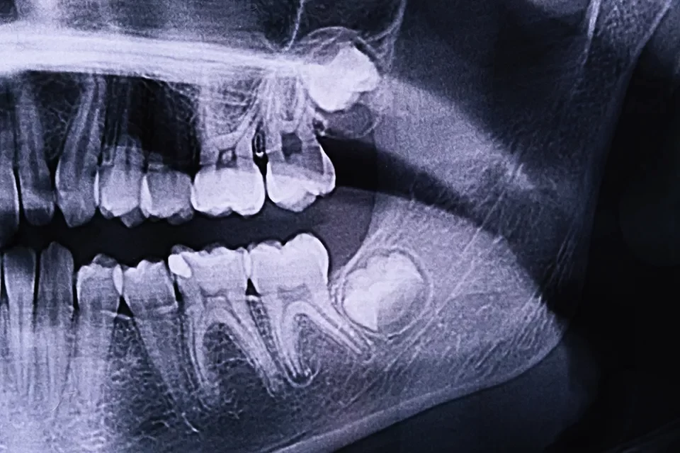 Impacted Tooth