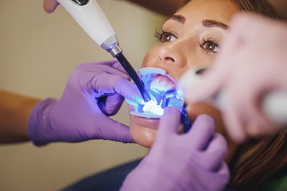 Dental Sealants