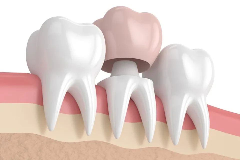 The Difference Between Veneers and Crowns