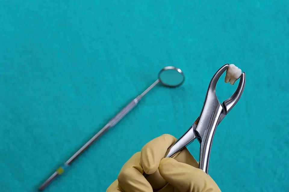 When Should Wisdom Teeth Be Removed? Key Timelines