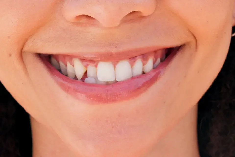 close up of a smile What Are Porcelain Veneers for Crooked Teeth?