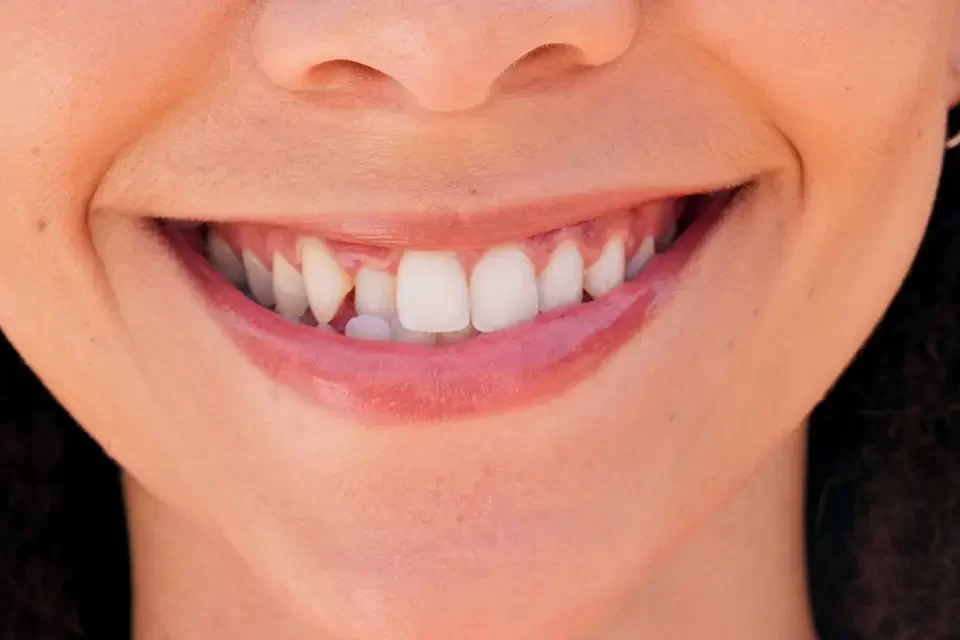 What Are Porcelain Veneers for Crooked Teeth?