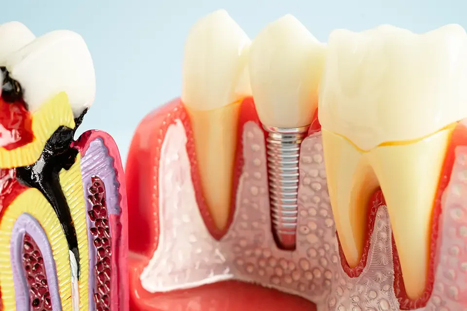 dental implants Dentures or Implants? Understanding the Basics