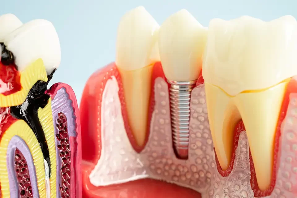 Dentures or Implants? Understanding the Basics