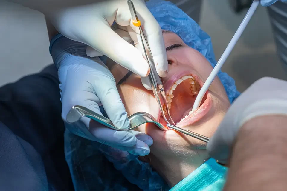 Pain After Multiple Extractions: The Typical Timeline