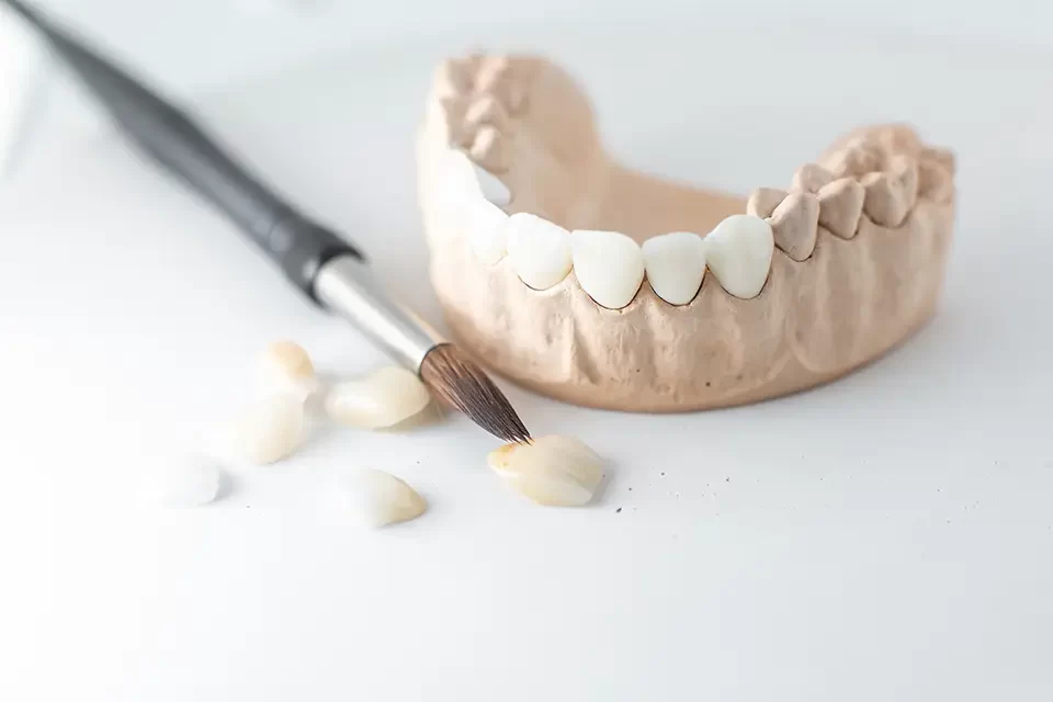 How Are Dental Crowns Made? Step 1 — Assessment & Smile Planning