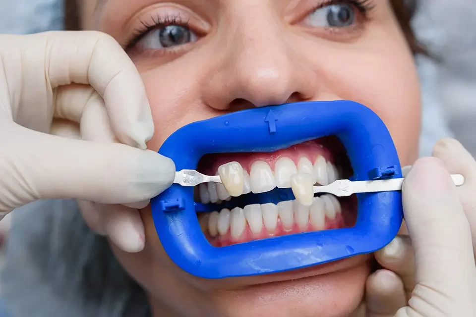Zoom Teeth Whitening Toronto: Step-by-Step, So There Are No Surprises
